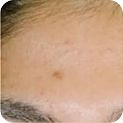 ニキビ跡の色素沈着（茶色）