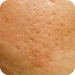 ニキビ跡の凹み（クレーター）